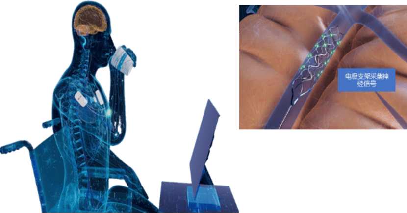 脑机接口风口下的价值重估，心玮医疗-B（6609.HK）的技术卡位与资本进阶